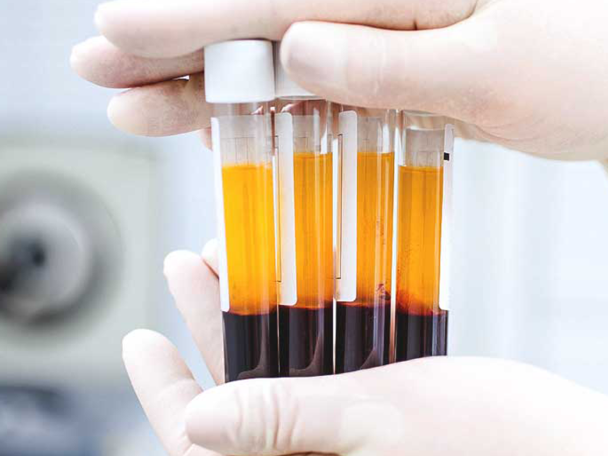 PRP Lichen Sclerosis – Extensive Area (2 Vials)